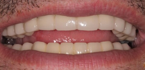 Протезирование зубов металлокерамическими мостами на имплантатах