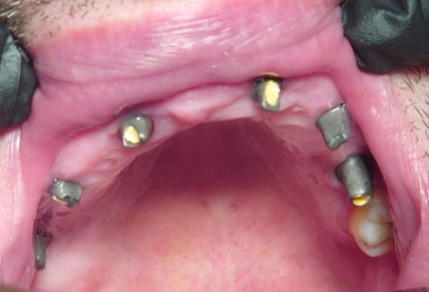 Протезирование зубов металлокерамическими мостами на имплантатах