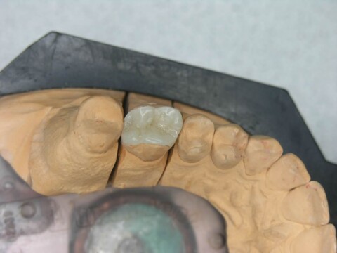 Протезирование зуба керамической вкладкой