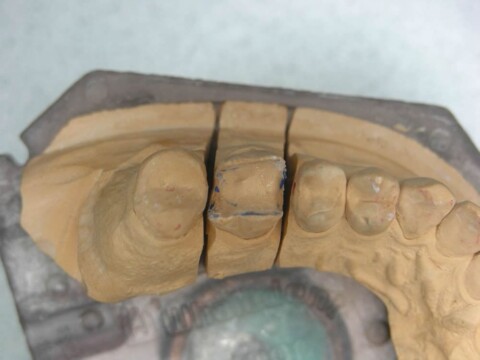 Протезирование зуба керамической вкладкой
