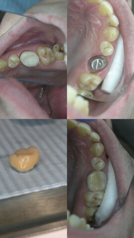 Протезирование зуба при полном разрушении клинической коронки - индивидуальной культевой вкладкой и сверху металлокерамическая коронка